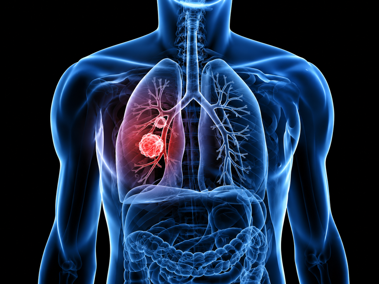 Lung Cancer Subtypes