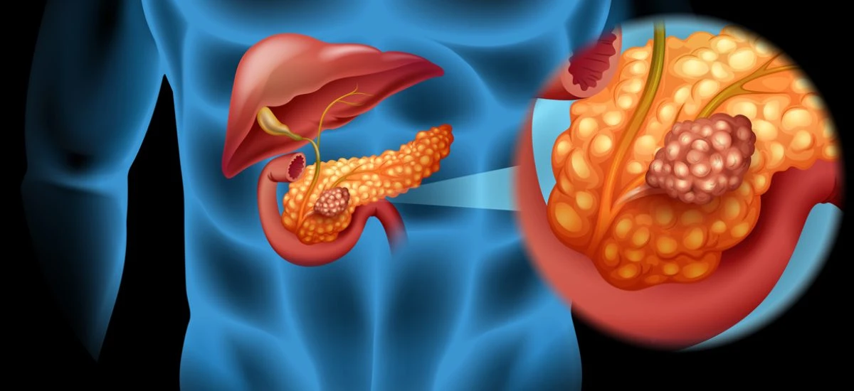 Pancreatic Cancer Care